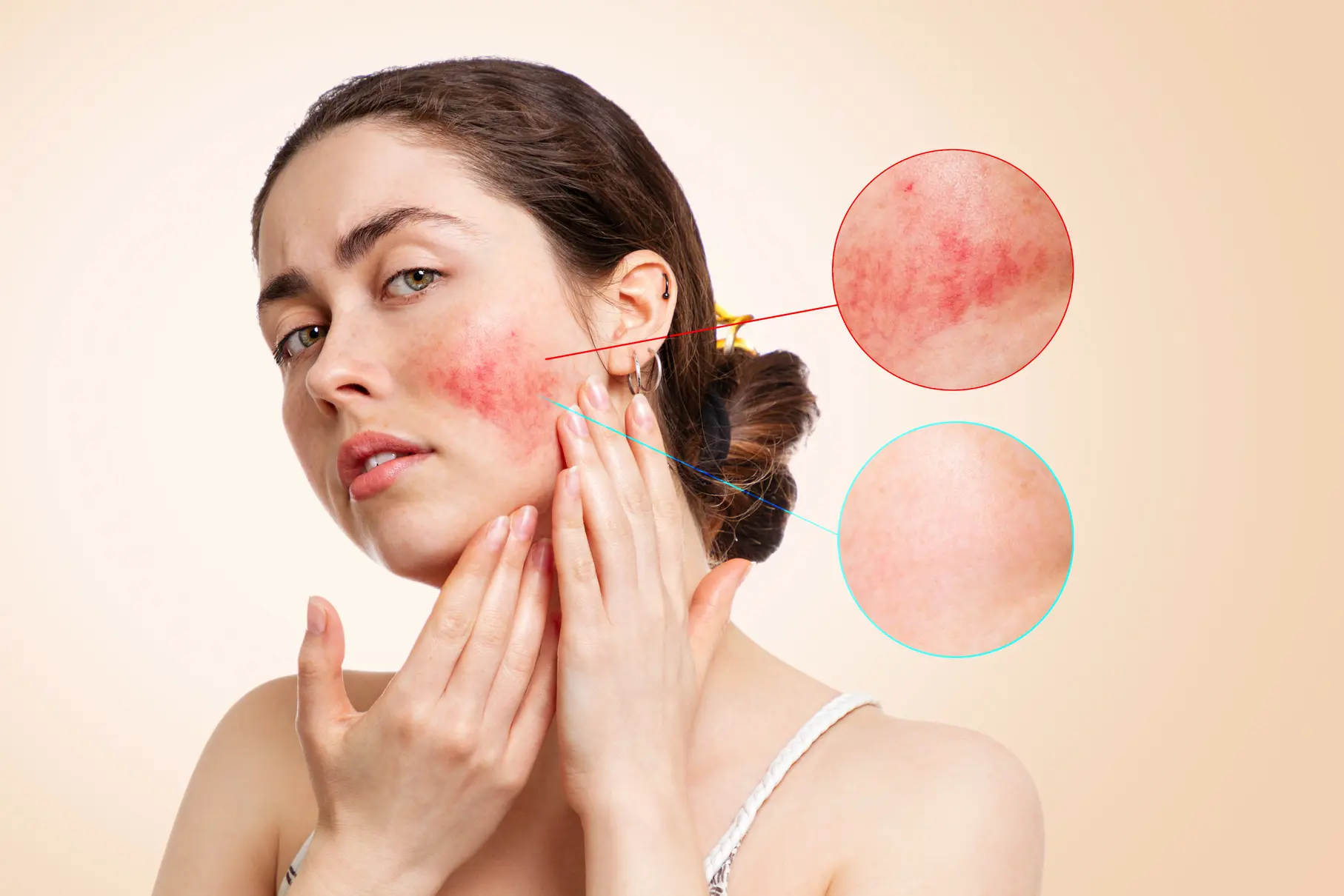 Can Laser Treatments Help Improve Rosacea | Ivy Aesthetics and Laser Spa in Memphis, TN